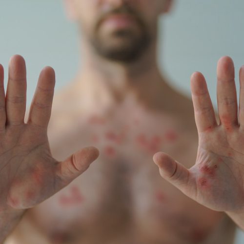 Male hands affected by blistering rash because of monkeypox or other viral infection on white