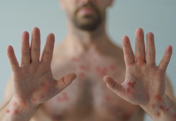 Male hands affected by blistering rash because of monkeypox or other viral infection on white