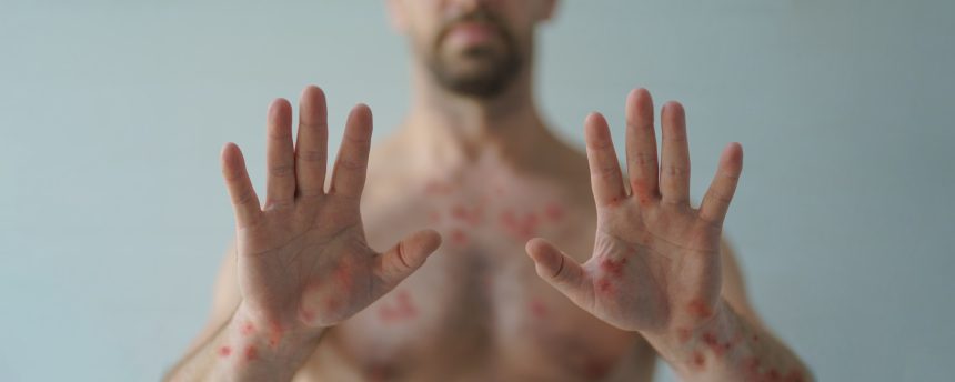 Male hands affected by blistering rash because of monkeypox or other viral infection on white