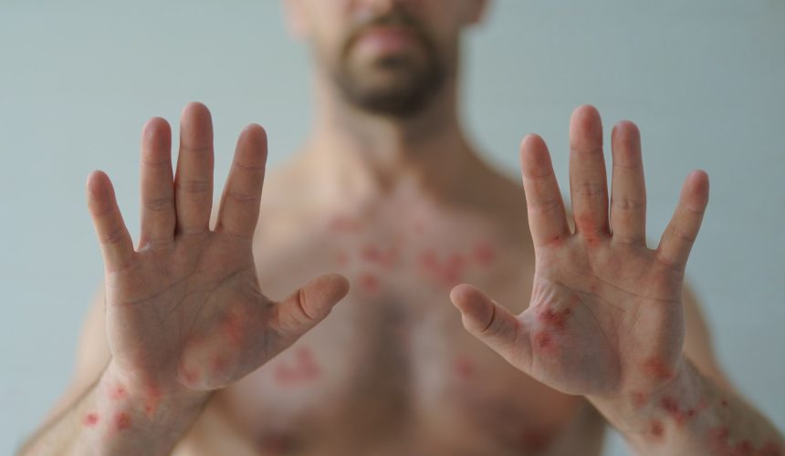 Male hands affected by blistering rash because of monkeypox or other viral infection on white